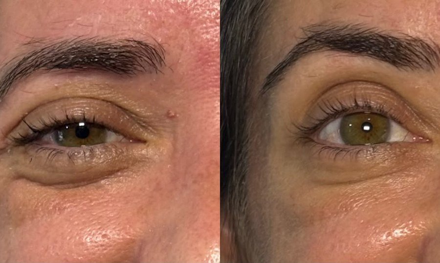 Antes e depois de aplicação de botox na região dos olhos