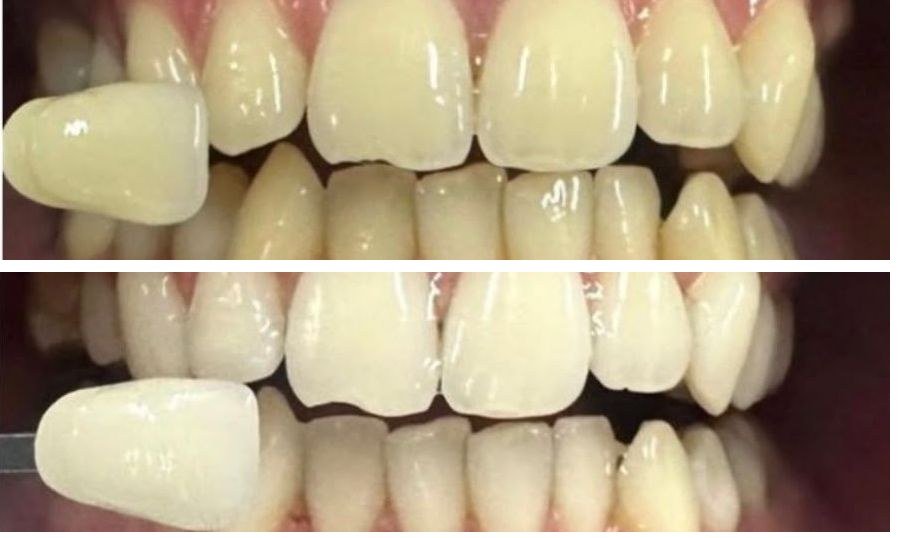 Antes e depois de clareamento dental