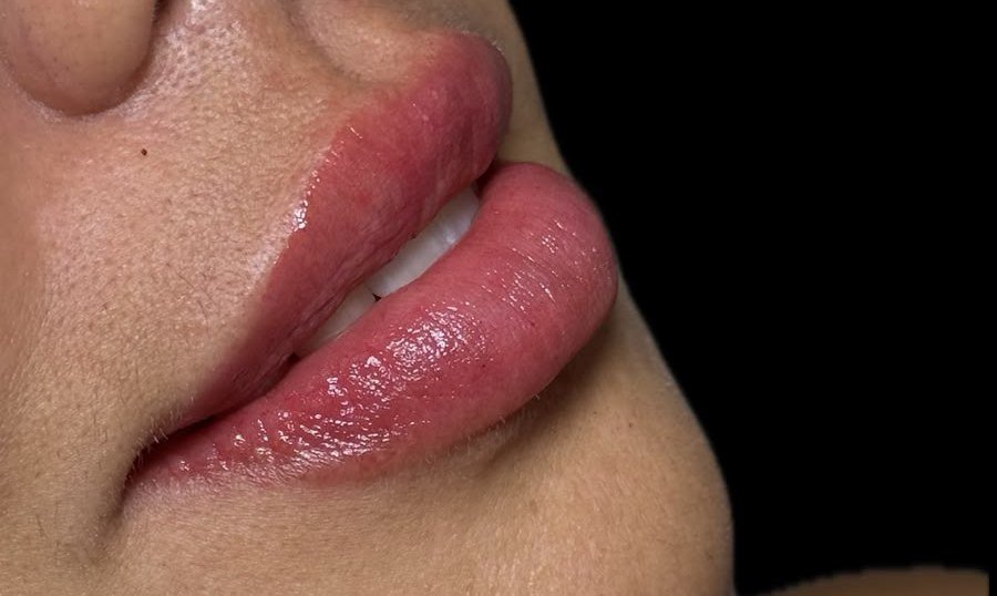 Resultado de preenchimento labial