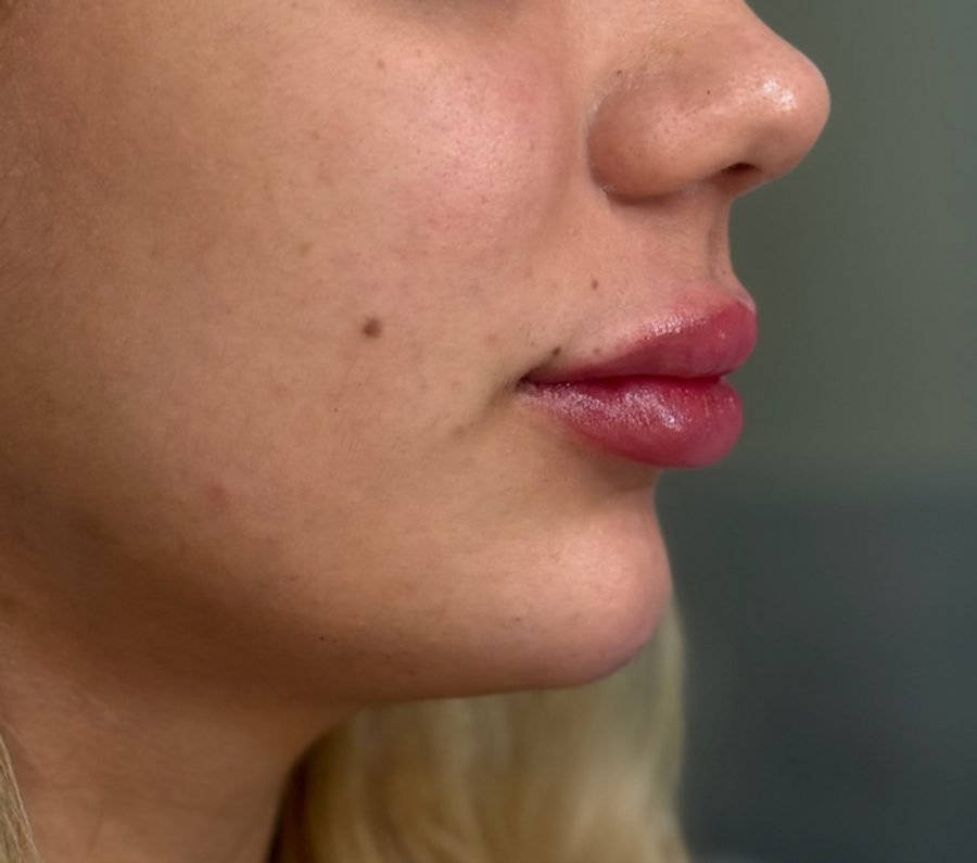 Perfil após preenchimento de mento